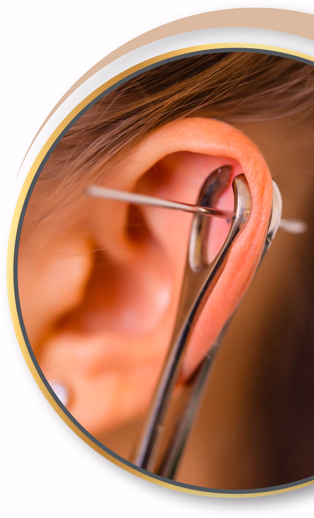 Akupunktur Piercing von Nadelkust für Baesweiler